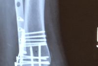 Recovering from Trimalleolar Fracture Surgery: Timeline & Tips