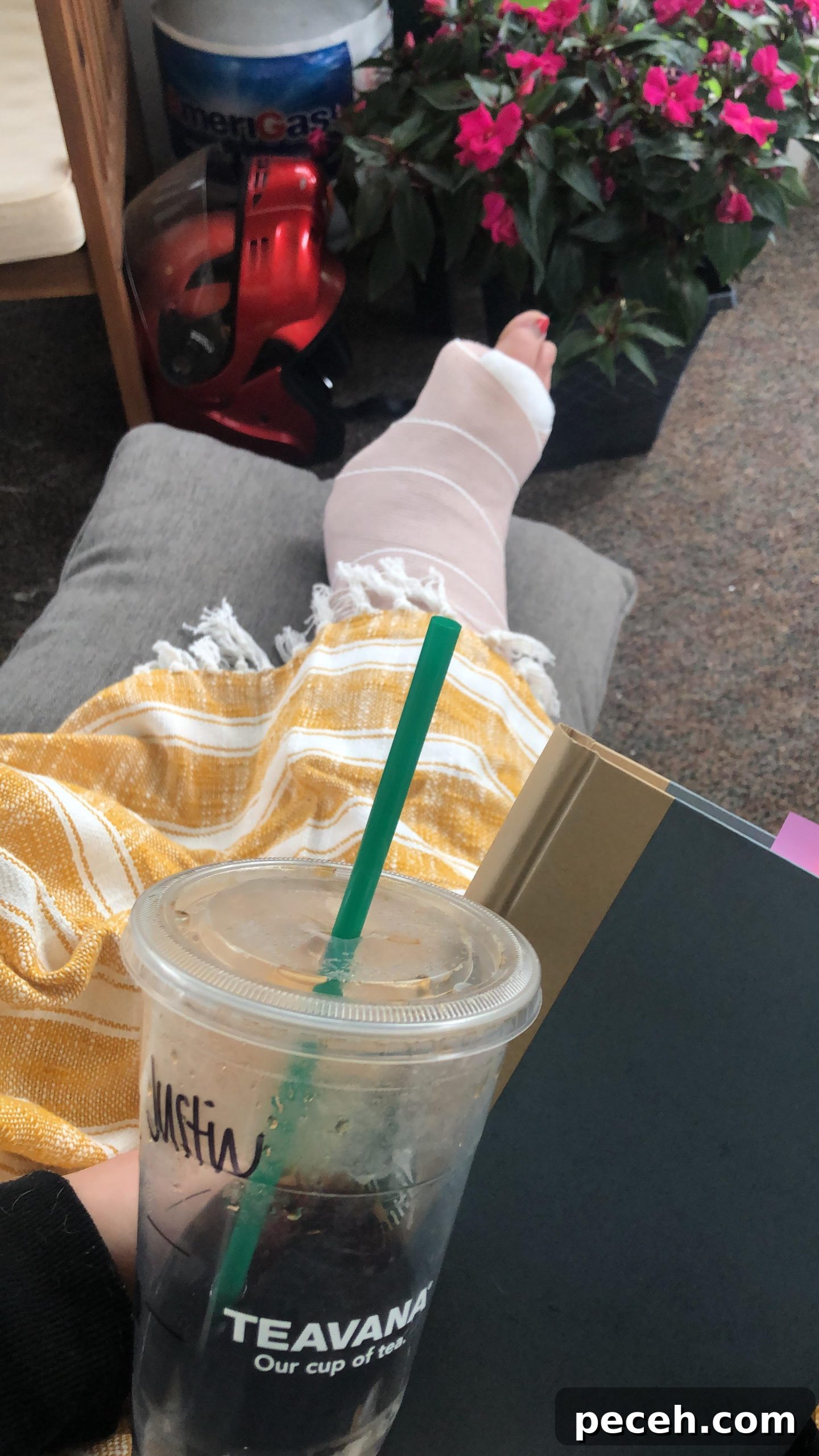 Recovering from Trimalleolar Fracture Surgery: Timeline & Tips 3 img 7257 2 scaled