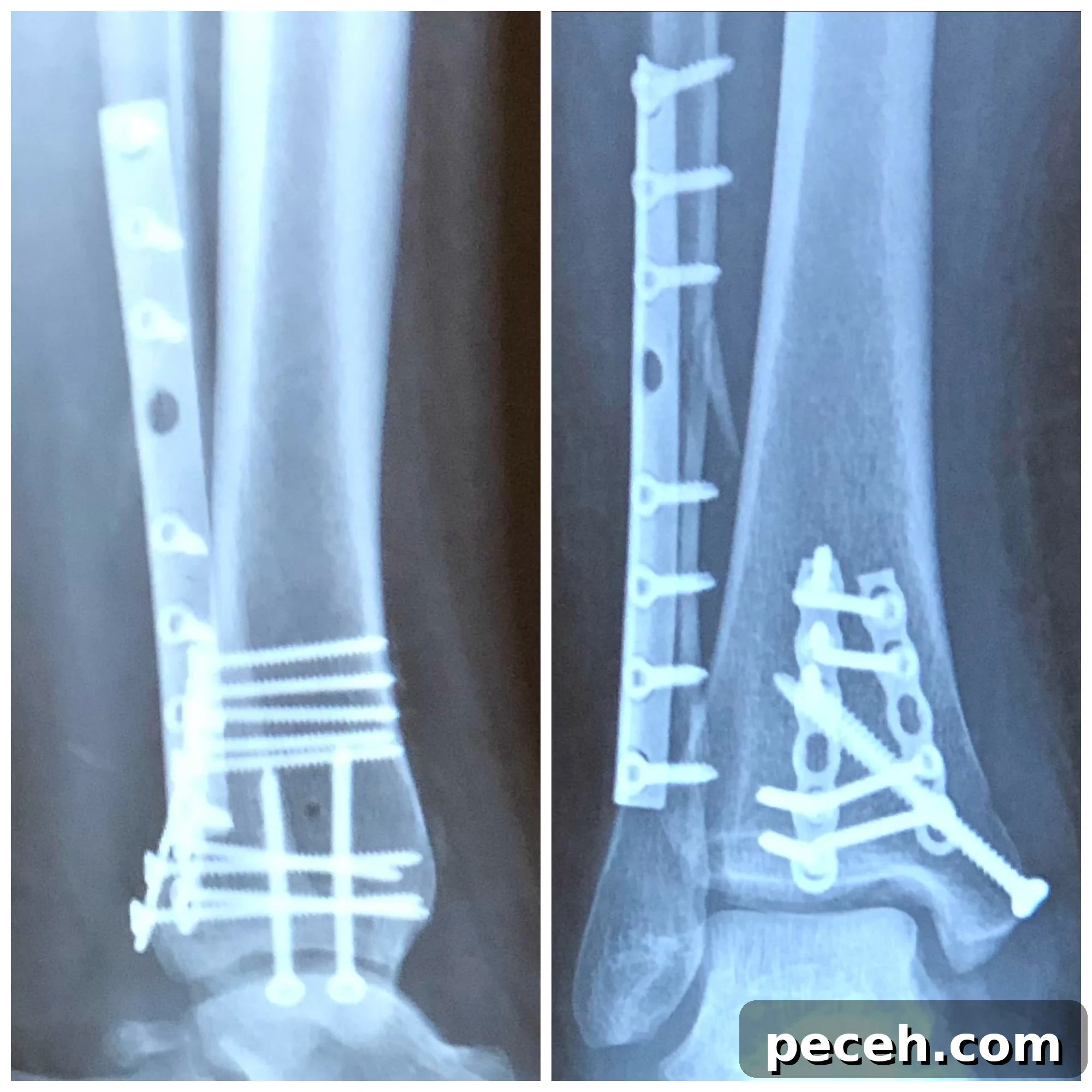 Recovering from Trimalleolar Fracture Surgery: Timeline & Tips 4 trimalleolar fracture surgery