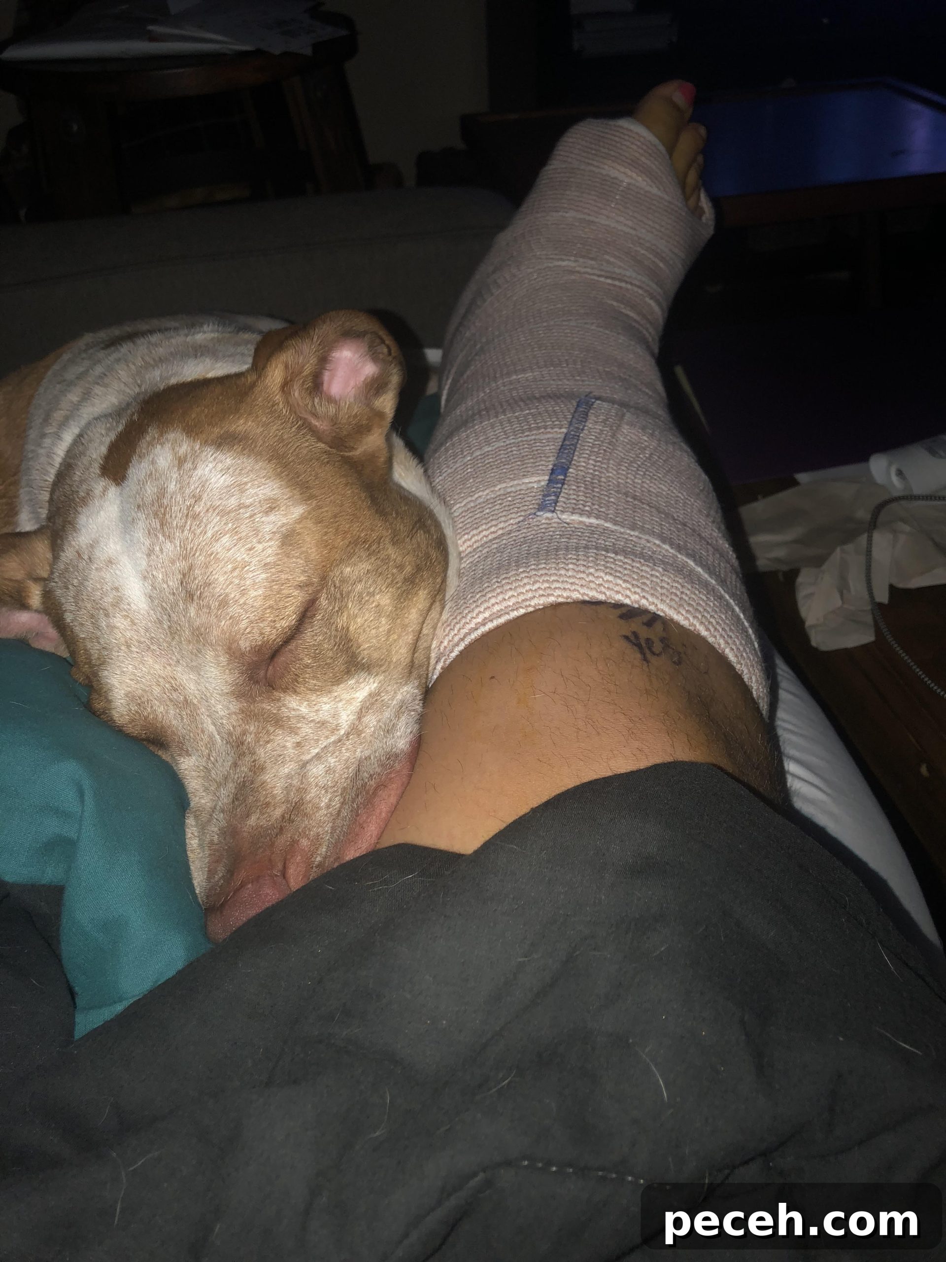 Recovering from Trimalleolar Fracture Surgery: Timeline & Tips 5 trimalleolar fracture surgery