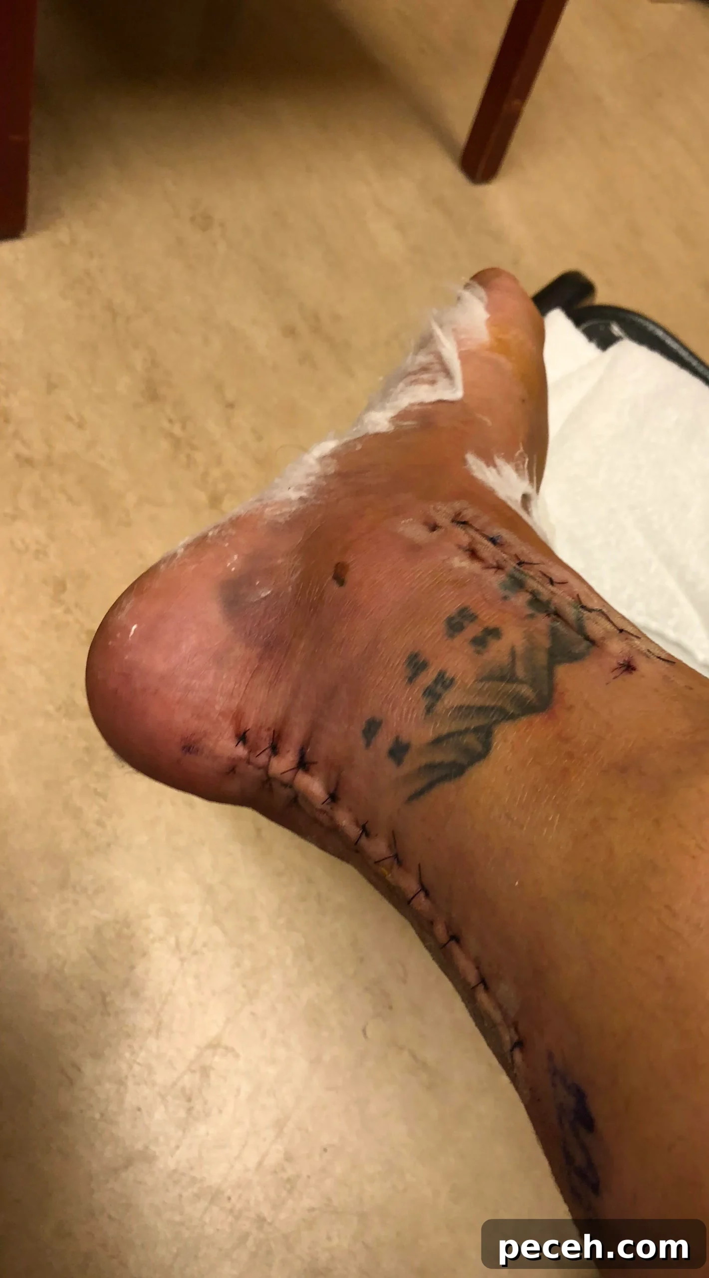 Recovering from Trimalleolar Fracture Surgery: Timeline & Tips 7 img 7257 6 scaled